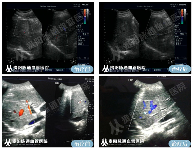 【贵阳血管瘤治疗案例】智能腔内综合治疗前后对比 5.jpg