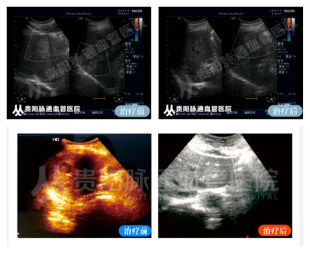 【贵阳血管瘤治疗案例】智能腔内综合治疗前后对比 7.jpg