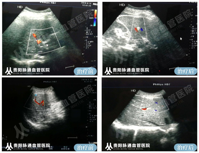 【贵阳血管瘤治疗案例】智能腔内综合治疗前后对比 6.jpg