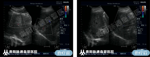 【贵阳血管瘤治疗案例】智能腔内综合治疗前后对比4